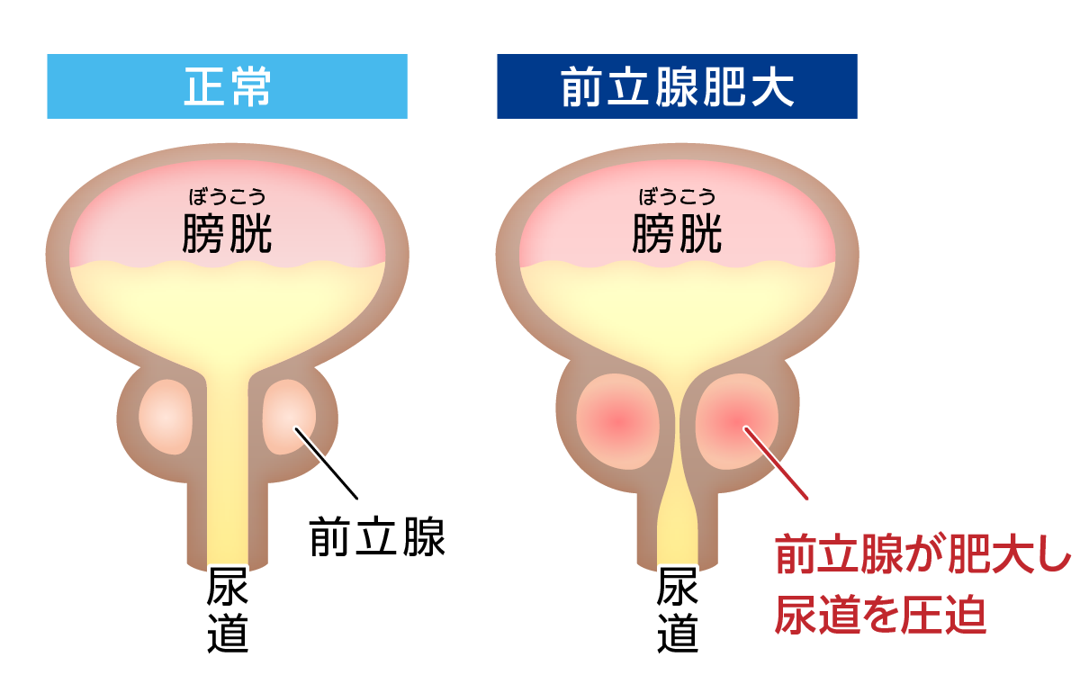 前立腺肥大症に伴う尿トラブル